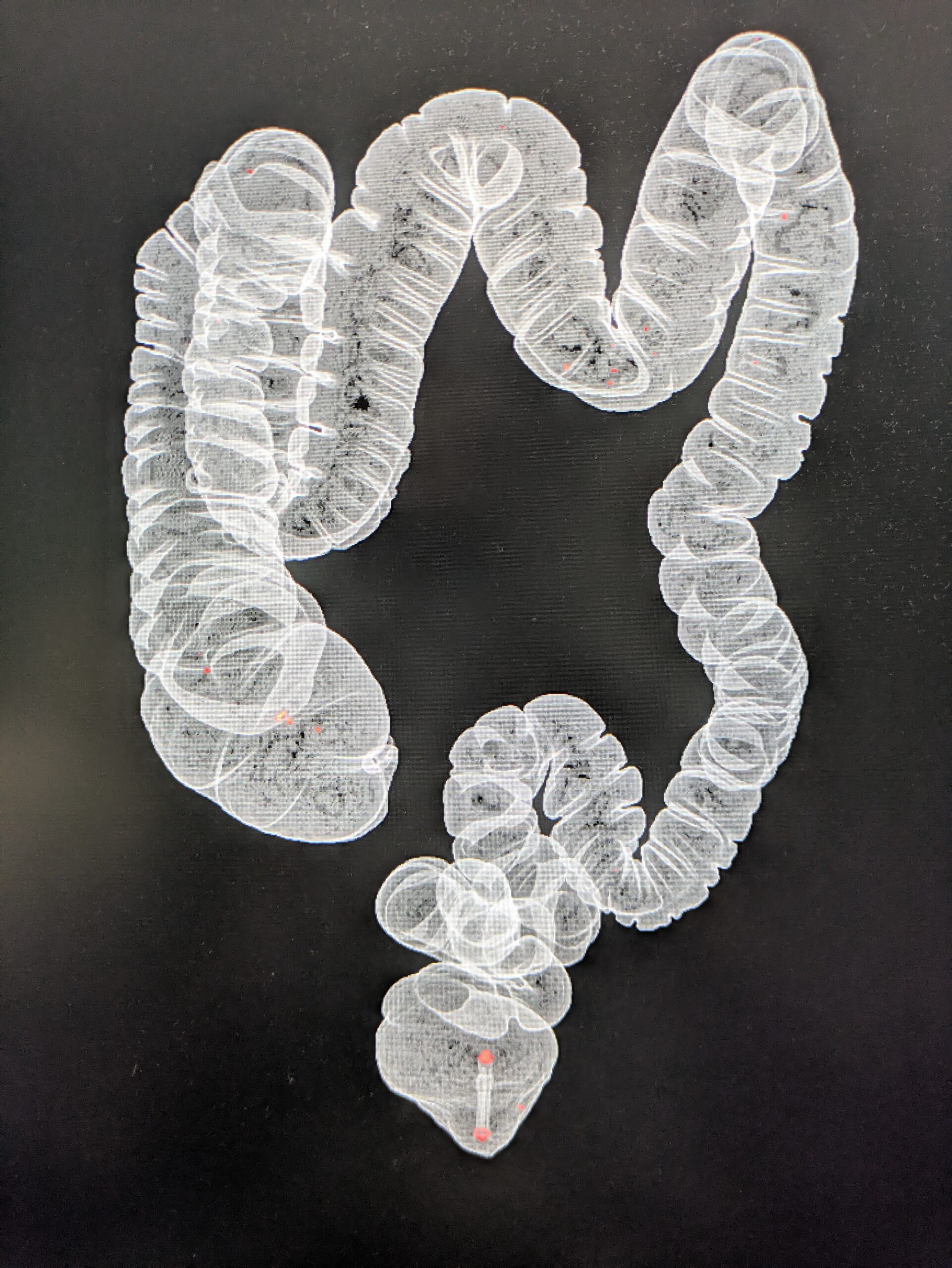 【大腸CT検査の体験談】50代おじさんが受けてみた！下剤も楽ちんな新常識